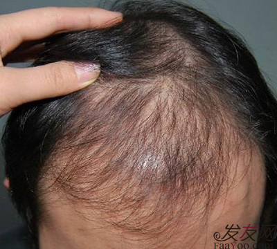 脫發(fā)是腎虛引起的嗎？