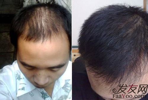 快速治療脫發(fā)的方法是什么？