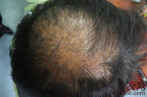 造成現(xiàn)代男性脫發(fā)的原因主要有哪些？