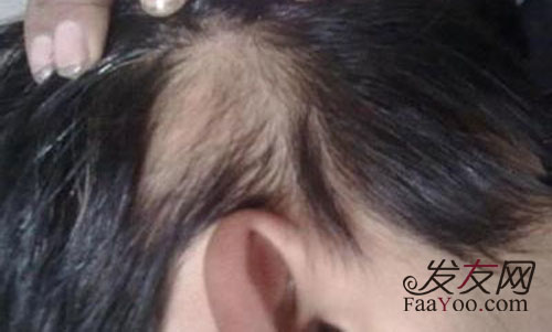 有效治療斑禿的偏方都有哪些？