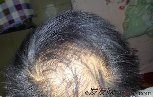 關(guān)于治男性脫發(fā)的偏方都有哪些？