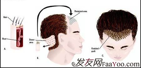 男性脫發(fā)了，應該怎么辦？脫發(fā)的男性必看 