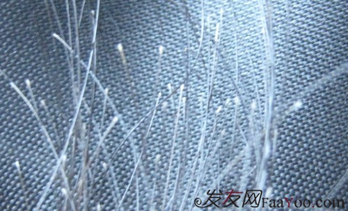 哪些原因能夠引起斑禿脫發(fā)？