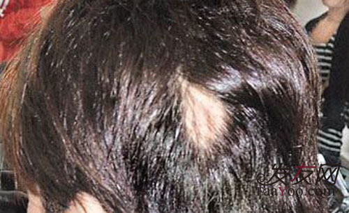 能夠治療斑禿的偏方有哪些？