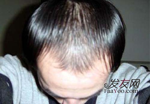 男性脫發(fā)治療較好的方法都有什么呢?　