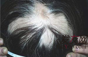 治療斑禿脫發(fā)較好的方法都有什么呢?　