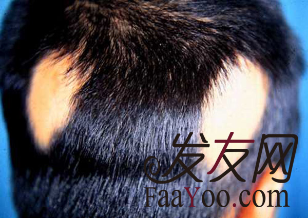治療斑禿較好的方法有哪些呢? 