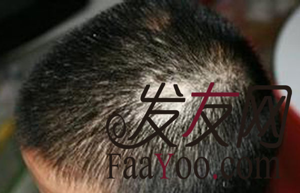 治療斑禿的方法，跟照成斑禿的原因是什么？