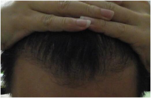 [3級(jí)脫發(fā)植發(fā)經(jīng)歷] 分享　