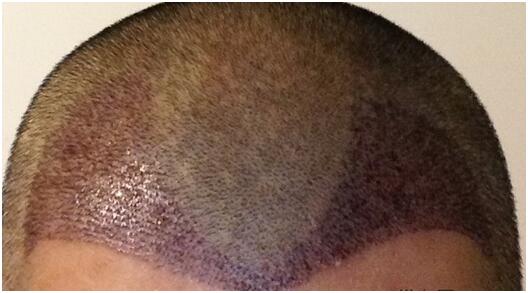 [前額植發(fā)] 植發(fā)2500單位　