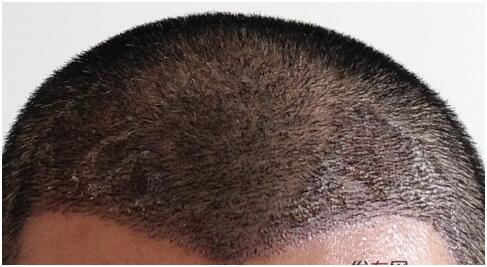 [前額植發(fā)] 植發(fā)2500單位　