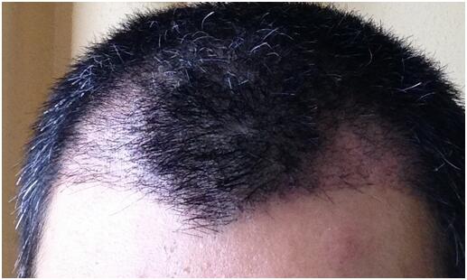 [前額植發(fā)] 植發(fā)2500單位　