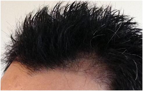 [前額植發(fā)] 植發(fā)2500單位　