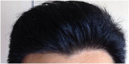 [前額植發(fā)] 植發(fā)2500單位　