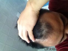 上海植發(fā)，一起見(jiàn)證一年的植發(fā)效果，有圖有真相