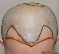 上海植發(fā)2000單位，植發(fā)10個(gè)月效果圖分享