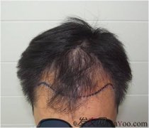 上海無(wú)血痂植發(fā)3300單位，效果已經(jīng)8個(gè)月了（圖）