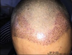 上海植發(fā)900FUE加密修復(fù) 持續(xù)更新常駐1年