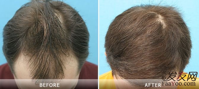 植發(fā)前后對照圖