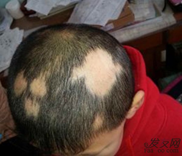 突然出現(xiàn)斑禿該怎么辦？