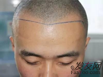 雄性激素脫發(fā)常常表現(xiàn)為什么癥狀？