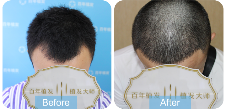 發(fā)際線種植，上交作業(yè)啦！