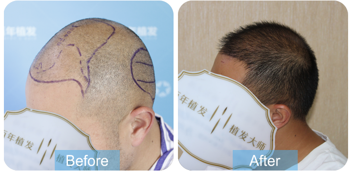 發(fā)際線調(diào)整，年輕帥氣回來了！