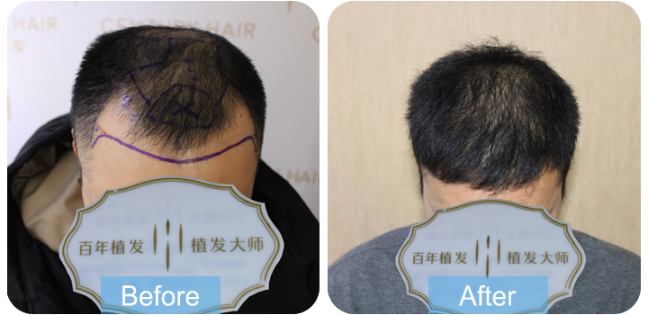 分享我的植發(fā)經(jīng)歷，效果驚人！