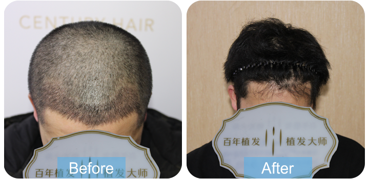 前額植發(fā)，改變自己！