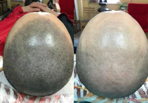 紋發(fā)--治療脫發(fā)的一種新型手段