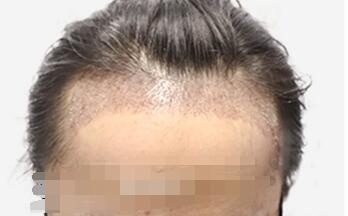 碧蓮盛的植發(fā)技術可靠嗎？有什么優(yōu)勢呢？