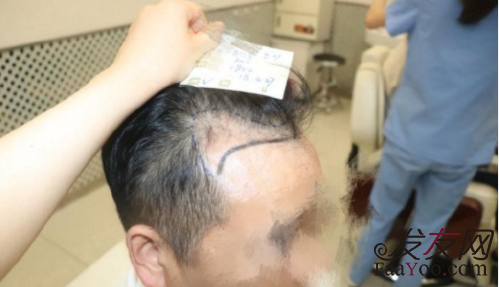 上海科植倍信植發(fā)技術(shù)怎么樣？（附發(fā)際線種植案例）