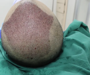 昆明植發(fā)醫(yī)院排名前五|碧蓮盛植發(fā)、人民醫(yī)院、雍禾植發(fā)植發(fā)等上榜!