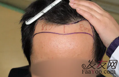 植發(fā)手術(shù)常說的一個(gè)毛囊單位指的是一根頭發(fā)嗎？