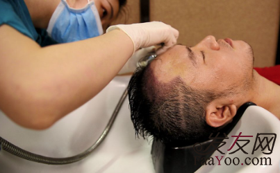 科普：植發(fā)后為什么會(huì)出現(xiàn)水腫？多久可以消腫？