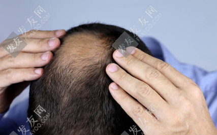 頭頂稀疏怎么辦？植發(fā)加密技術(shù)效果怎么樣？