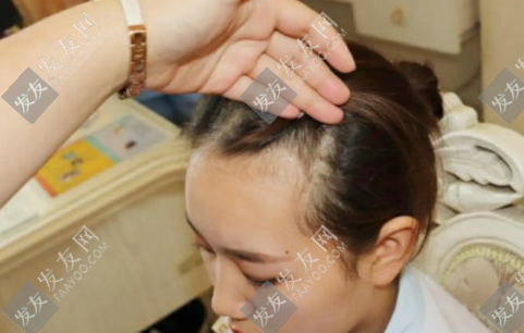 植發(fā)后頭發(fā)掉的更厲害是怎么回事？是手術(shù)失敗了嗎？