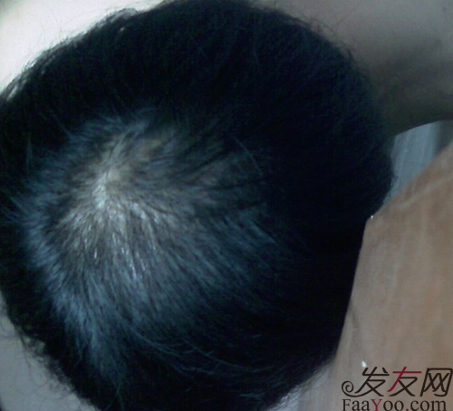 病理性脫發(fā)需要合理飲食，文章圖片１