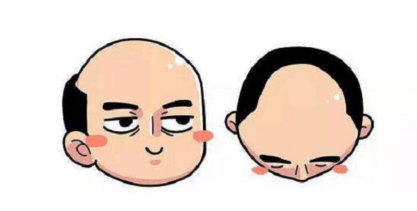 掉頭發(fā)到什么程度就可以去植發(fā)