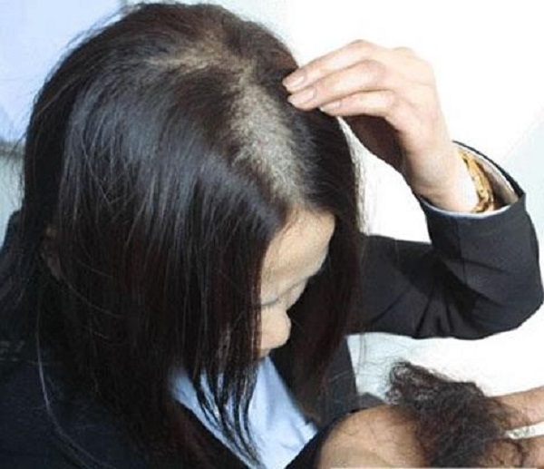 怎么治療鬼剃頭