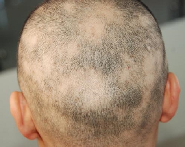 怎么治療鬼剃頭