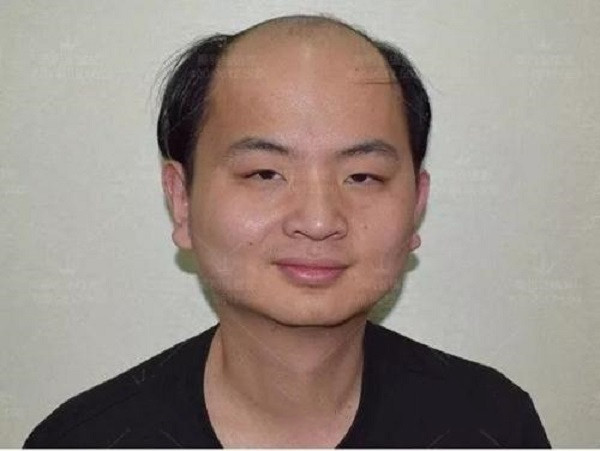 發(fā)際線后移應(yīng)該要怎么辦