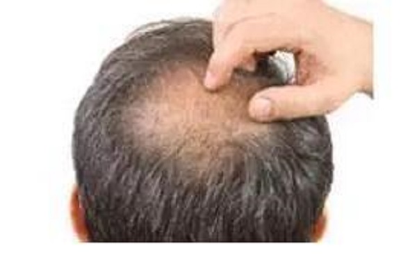 腎虛型脫發(fā)能夠自愈嗎