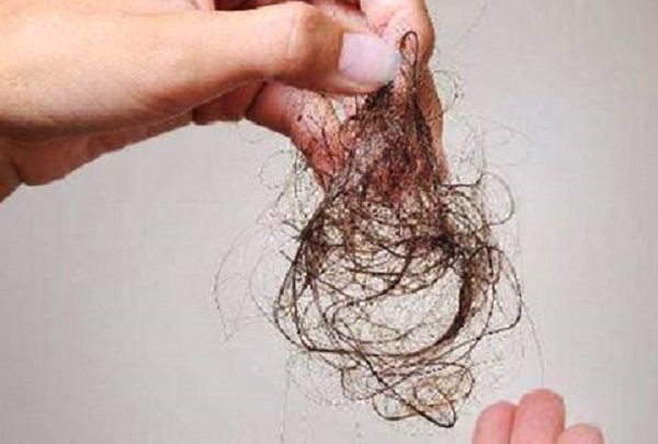 怎么治療物理性脫發(fā)