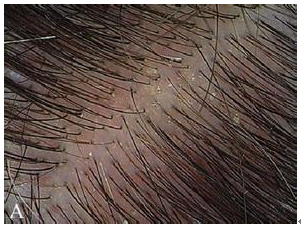 脂溢性脫發(fā)和熬夜有關(guān)系嗎