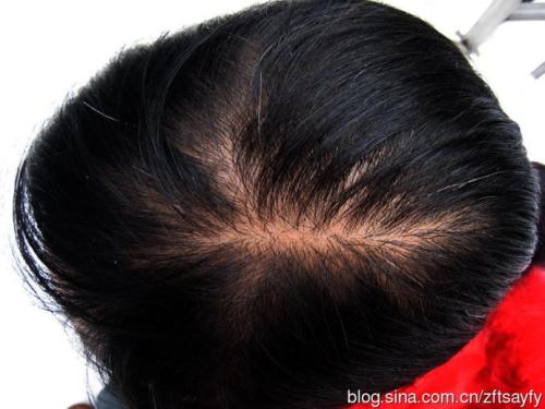 脂溢性脫發(fā)和熬夜有關(guān)系嗎