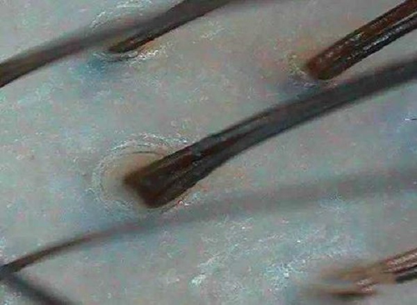 什么情況下毛囊會(huì)壞死