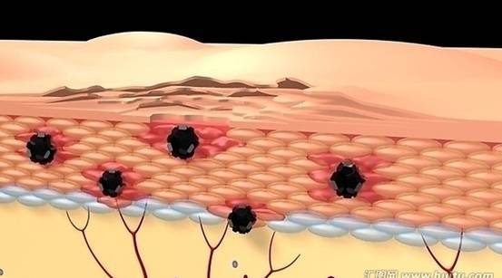 什么原因?qū)е铝嗣已讖?fù)發(fā)