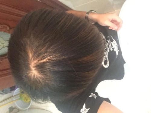 女性脂溢性脫發(fā)可以自愈嗎？