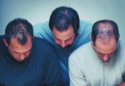 脂溢性脫發(fā)的特征表現(xiàn)